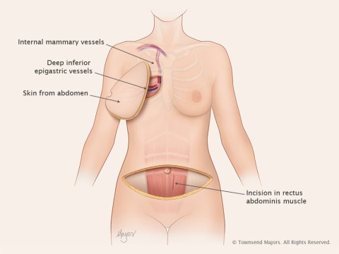 abdominal04_DIEPflap_chest1